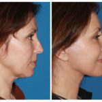 The Acupuncture Facelift