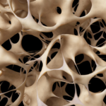 Unmasking Osteoporosis